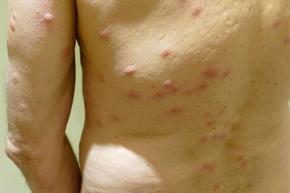 An individual with bed bug bites displays the pattern in this file photo, sourced via Wikimedia Commons.