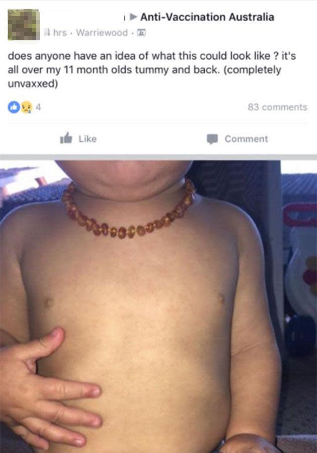 Instead of seeking out medical attention, a poster asks the forum for advice on her 'unvaccinated' child's mysterious rash.