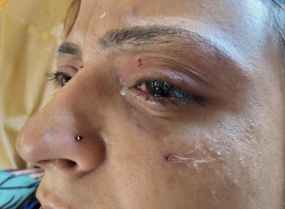 Rabiya, a Kashmiri woman, receives treatment for pellet injuries that left her with a blurred vision, at the Shri Maharaja Hari Singh hospital in Srinagar, Indian controlled Kashmir, Thursday, Aug. 8, 2019. Rabiya said that after hearing the government's announcement that Kashmir's special status had been stripped, she thought to buy vegetables, anticipating a long curfew period in Srinagar. "The moment I came out from my house, the soldiers out there shot at my direction," she said, as the couple's 2-year-old cried. (AP Photo/Sheikh Saaliq)