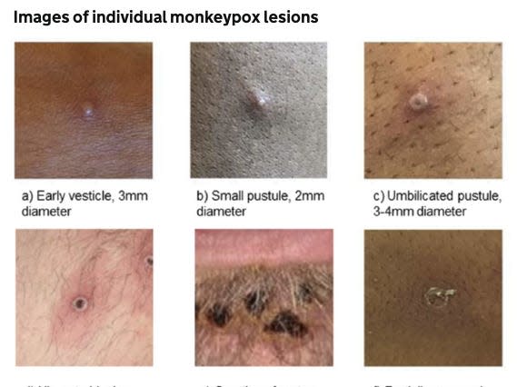 monkeypox lesions of different types