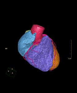 CTA Coronary artery image for detect coronary artery disease