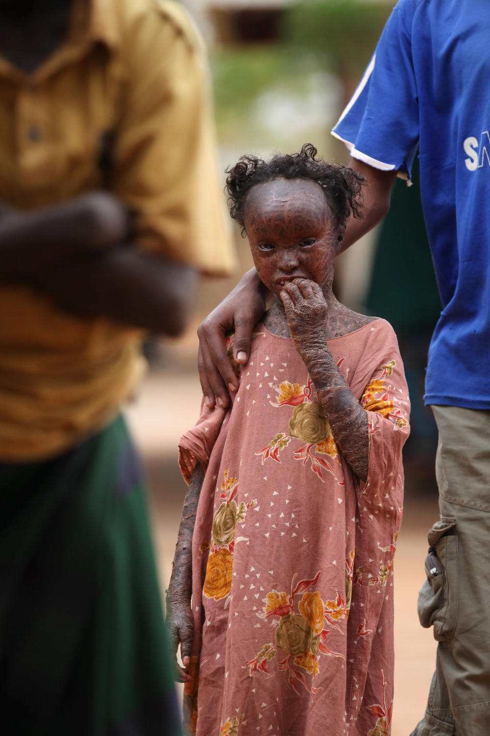 Displaced People At Dadaab Refugee Camp As Severe Drought Continues To Ravage East Africa