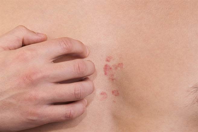 胸前常常長溼疹，而且擦了藥也好不了，小心可能是癌症前兆。(示意圖/達志影像)