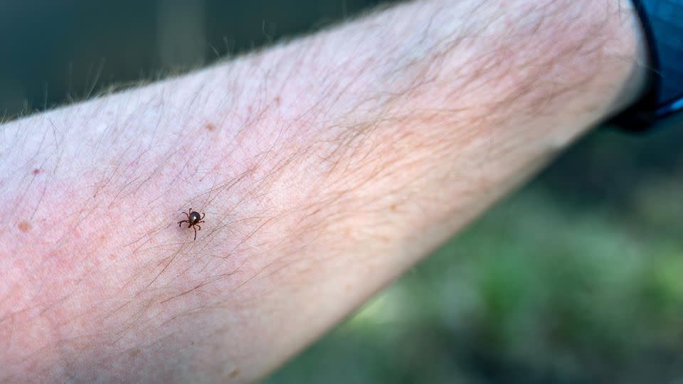 Be careful when removing a tick from your skin. Using tweezers, get the tick by its head as close to the skin as possible and pull it straight out. - Lost_in_the_Midwest/Alamy Stock Photo