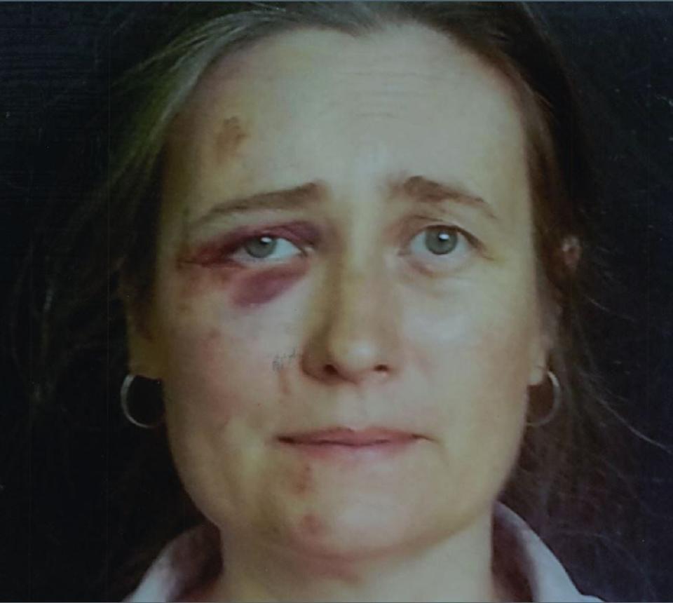 Heather Gunn says a North Carolina Highway Patrol trooper used excessive force in her 2018 arrest. She submitted this picture as evidence in a lawsuit against him.