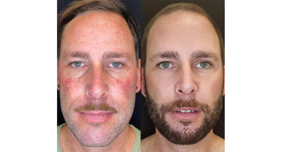 Before and after of man who has had skin treatment Laser Clinics