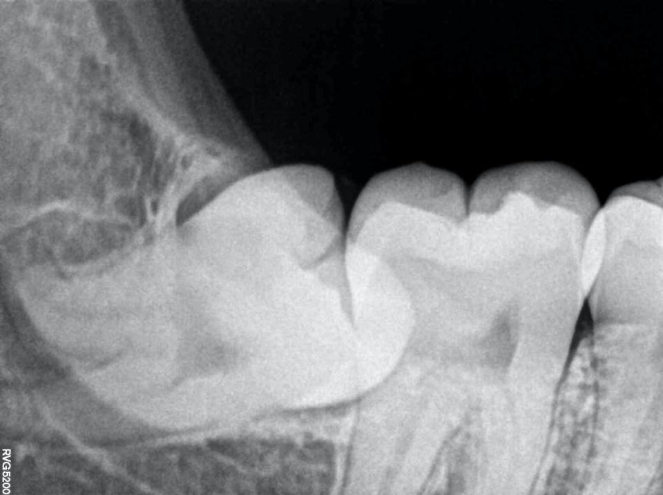 An impacted wisdom tooth will never come up properly. <a href="https://commons.wikimedia.org/wiki/File:Impacted_Wisdom_Tooth_aka_Lower_Right_Third_Molar_48_RVG_IOPA_Xray.jpg" rel="nofollow noopener" target="_blank" data-ylk="slk:Nizil Shah/Wikimedia Commons;elm:context_link;itc:0;sec:content-canvas" class="link ">Nizil Shah/Wikimedia Commons</a>, <a href="http://creativecommons.org/licenses/by-sa/4.0/" rel="nofollow noopener" target="_blank" data-ylk="slk:CC BY-SA;elm:context_link;itc:0;sec:content-canvas" class="link ">CC BY-SA</a>