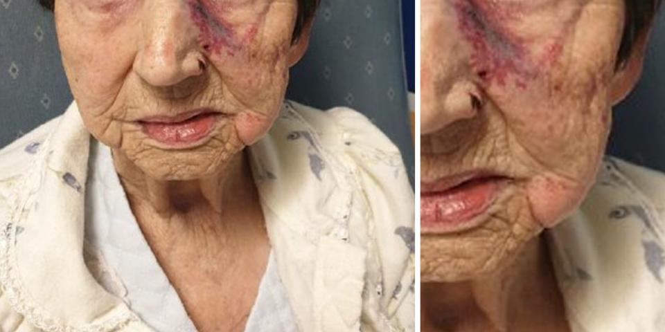 The injuries sustained by the elderly woman. (Merseyside Police)