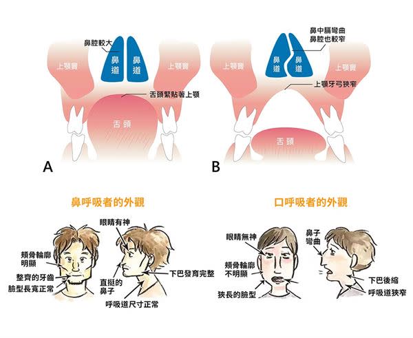 孩子打呼或夜間磨牙怎麼辦？成長型矯正增加口腔與呼吸道空間可讓孩子遠離口呼吸