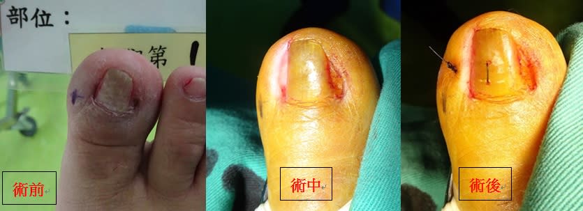 楊椒喬醫師的甲床重建術，達到傷口小、恢復快、不易復發及不需拔指甲「四合一」功效。（記者王正平翻攝）