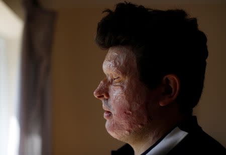 Acid attack victim Andreas Christopheros, poses for a photograph in his home in Truro, south-west England, Britain July 31, 2017. REUTERS/Peter Nicholls