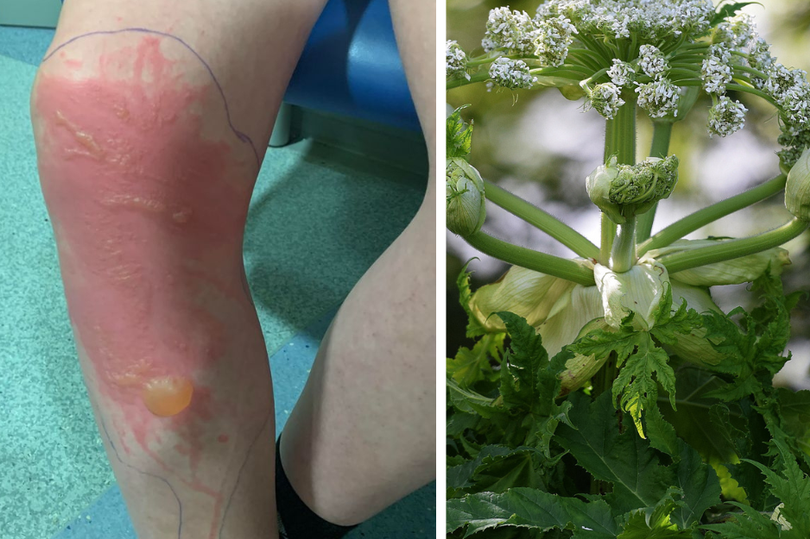 Teenager Michael Taylor's leg after his brush with Giant Hogweed