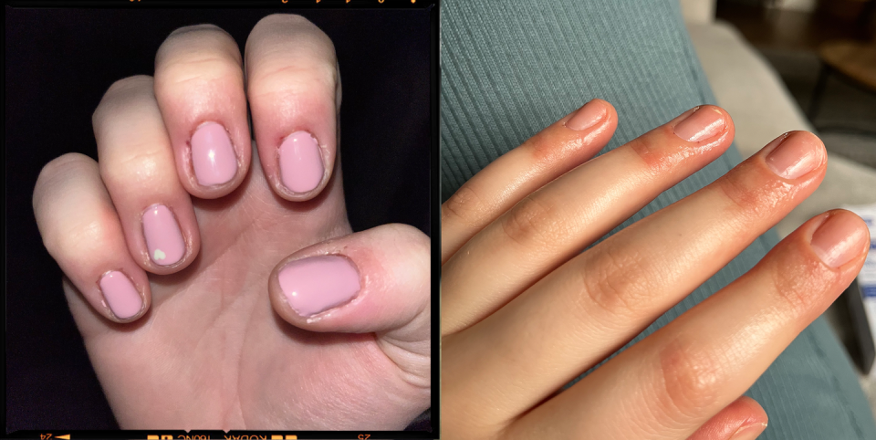 gel nail allergy