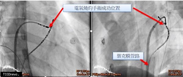 新竹臺大分院新竹醫院，採用傳統電燒方式以根除病人之沃夫-巴金森-懷特症候群，上方紅色箭頭為電氣燒灼手術成功位置處，下方紅色箭頭所指處為葉克膜管路。