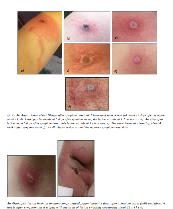 Examples of skin lesions for people who contracted the rare Alaskapox virus provided by the Alaska Division of Health.