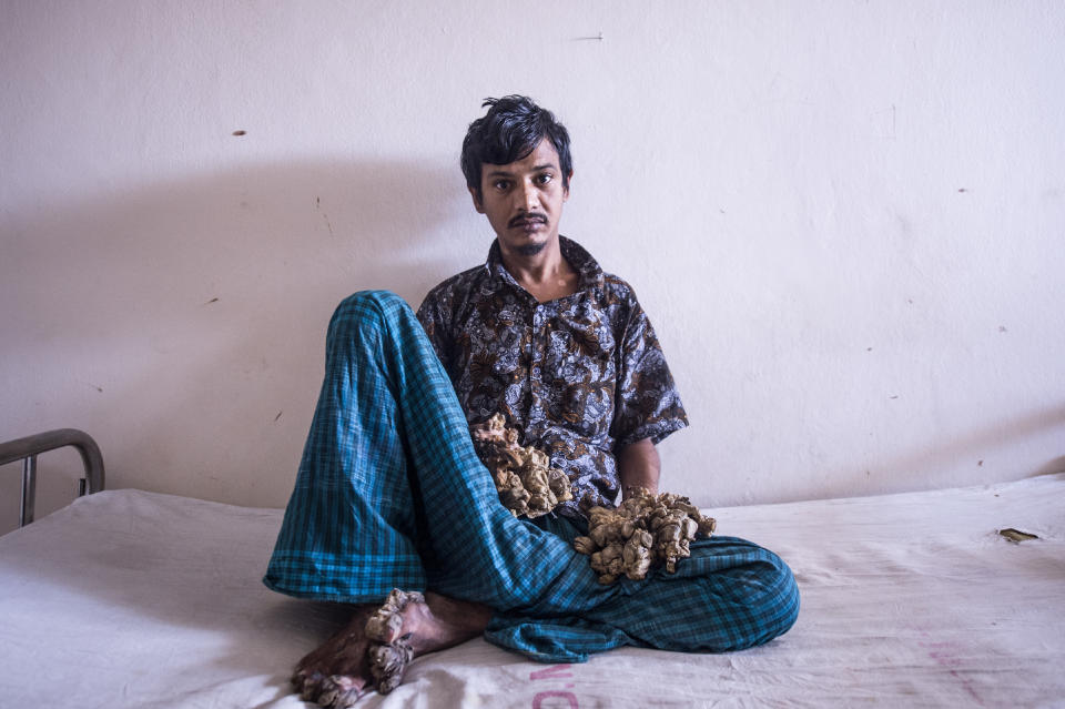 Abul Bajandar , 28, dubbed "Tree Man" for massive bark-like warts on his hands and feet.