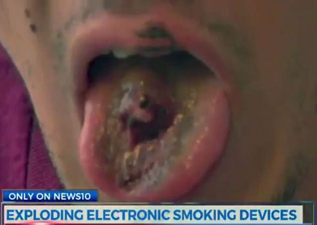 Mr Barbero lost teeth, split and burned his tongue. Source: ABC News 10