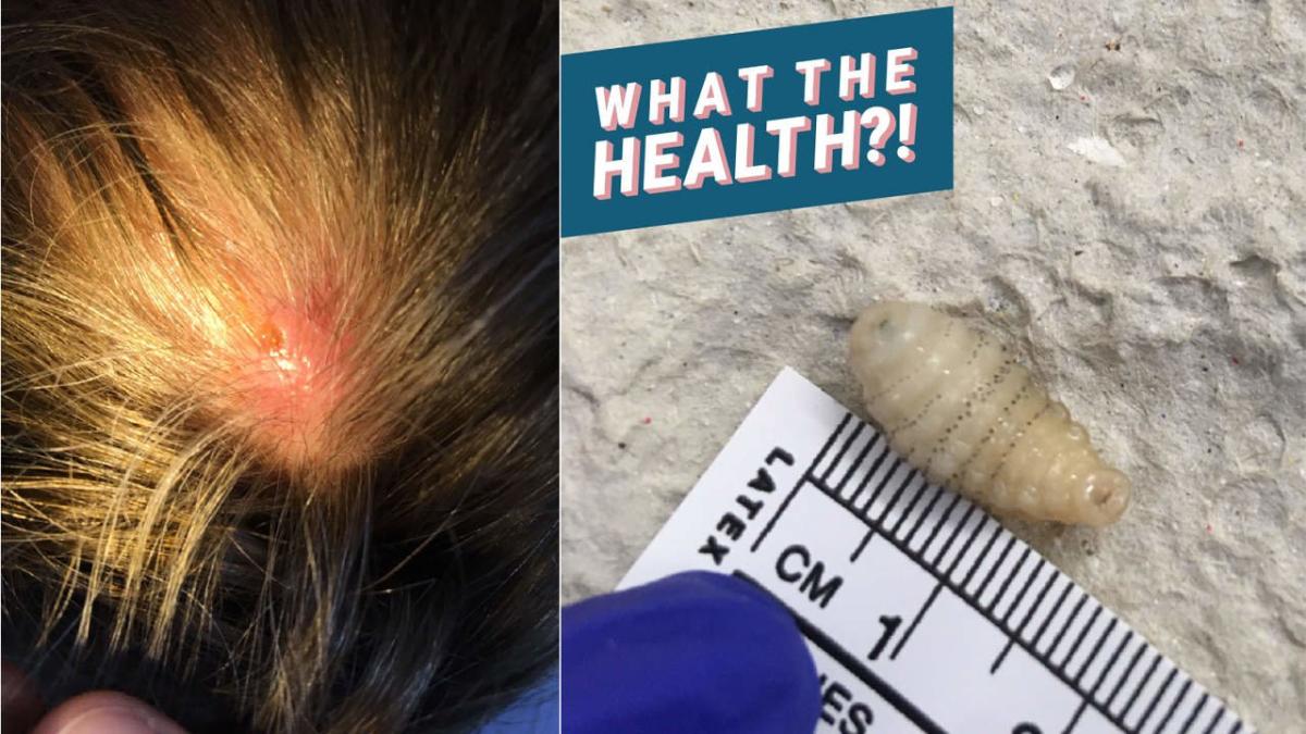 Two Maggots Burrowed in This Woman's Scalp While She Was on Vacation—Here's  How That Happens