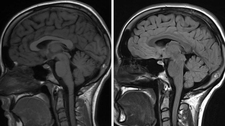 MRI scans showing a side view of a human brain