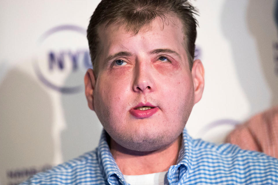 Patrick Hardison has had the world’s most extensive face transplant (Picture: Getty)