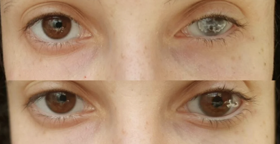 Closeup of a person's eyes showing how prosthetics improve the eye