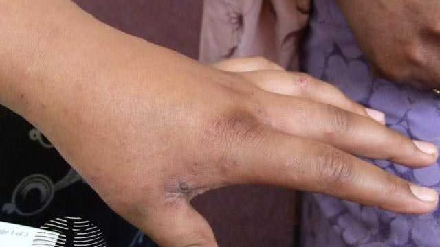 scabies skin rash