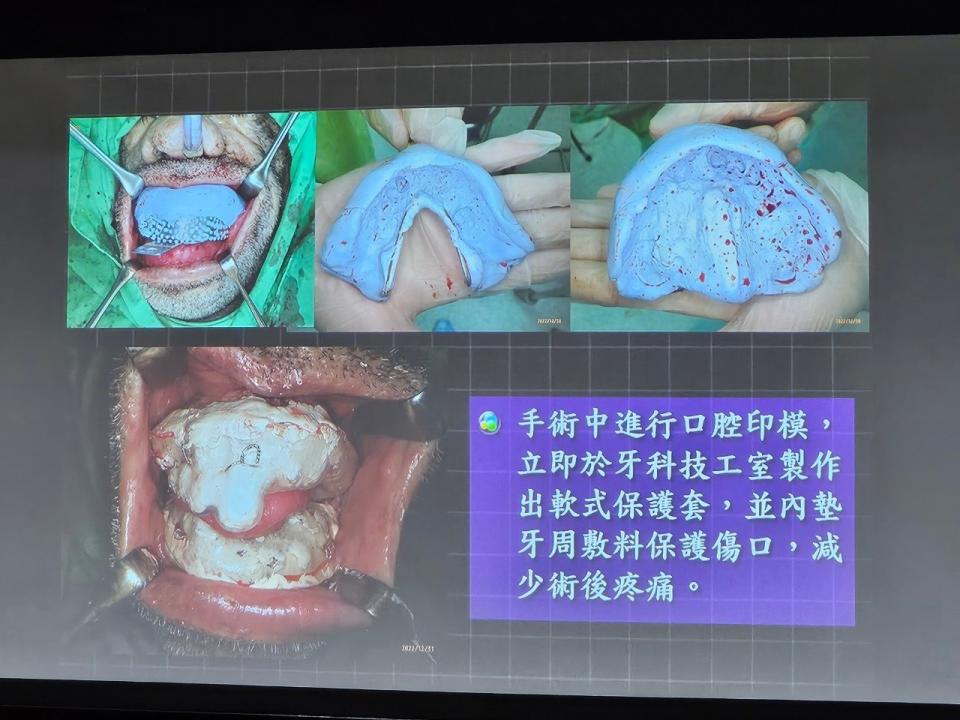 男罹遺傳性罕病20年無法咀嚼進食。施書瑜攝