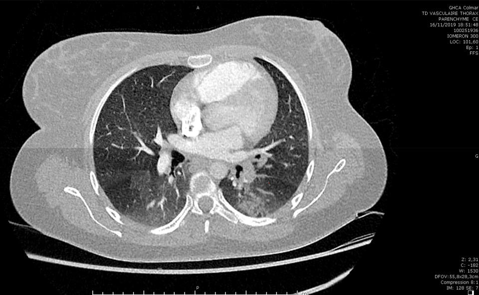 The scan of a suspected COVID-19 case under investigation by Dr. Michel Schmitt and his team. The first case can be traced back to November 16. (Courtesy Albert Schweitzer Hospital)