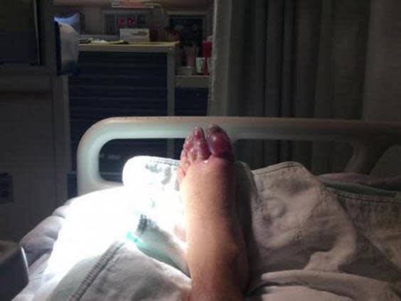 Nick Griffiths had to have three toes amputated after suffering from severe frostbite (SWNS)