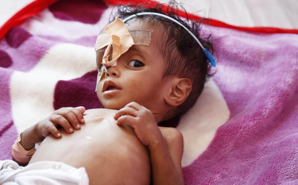 An infant suffering from malnutrition receives treatment at Sabeen Hospital in Sanaa, Yemen - Anadolu Agency 