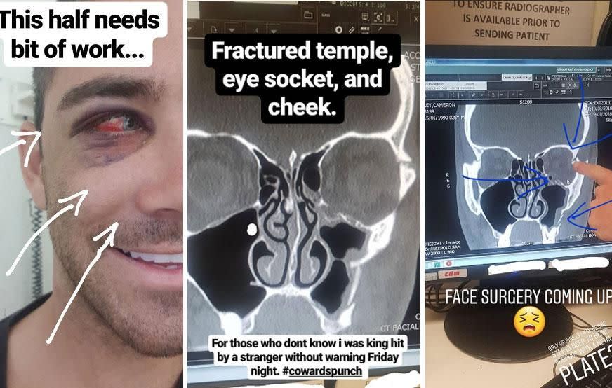 The Bachelorette star informed fans on Monday that he will be going into surgery by the end of the week, after fracturing his temple, eye socket and cheek. Source: Instagram/camcranley