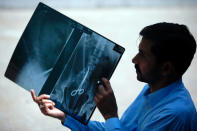 Safdar Ali Shah, 36, displays his medical X-ray sheet with a scissor in his lower abdomen outside the Karachi Press Club April 9, 2012. Shah said he went to a hospital on April 7, 2012 for a medical checkup due to continued pain in his abdomen, and was shocked when doctors identified that he has a scissor in his abdomen which was left by a medical team who performed his operation back in 2000. REUTERS/Akhtar Soomro
