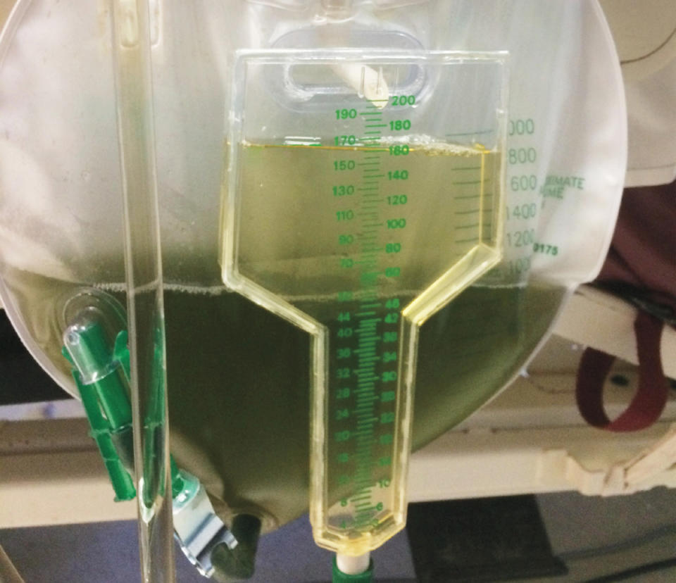 Green urine is seen in a medical bag.
