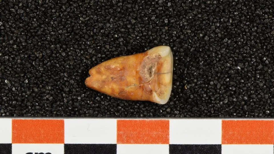 A human tooth unearthed from Taforalt Cave in Morocco shows severe wear and caries, or cavities. - Heiko Temming