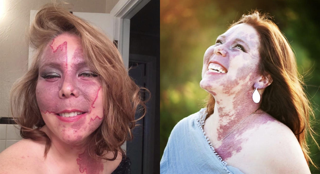 Anne Antonelli has learned to accept her birthmark. [Photo: Caters]