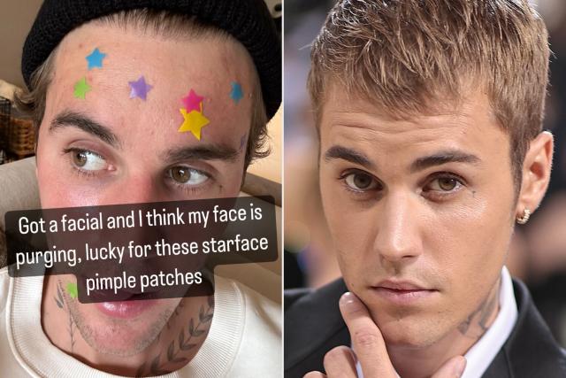 Justin Bieber could keep face paralysis for a long time, medical  professionals warn