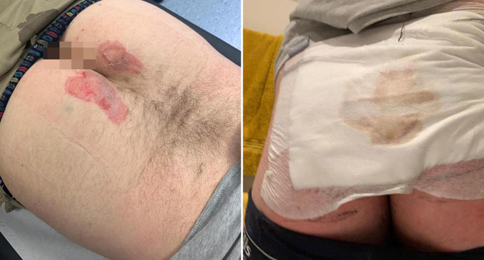 Pictured is the burned buttocks of Nathan Davies on the left and right with a bandage on his injuries. He was a chef at Calcot Manor and claims a coworker threw hot butter down his pants.