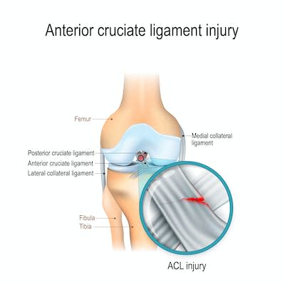 Las roturas del LCA son temidas debido a su largo tiempo de recuperación y a la posibilidad de volver a lesionarse. (Shutterstock)