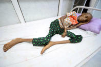 Saida Ahmad Baghili, 18, lies on a bed at the al-Thawra hospital where she receives treatment for severe malnutrition in the Red Sea port city of Hodeidah, Yemen October 24, 2016. REUTERS/Abduljabbar Zeyad