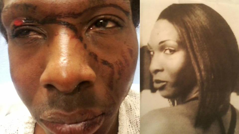Breona “BB” Hill received the injuries in the left photo after a violent altercation with Kansas City Police Department officers that was caught on video by a passerby.