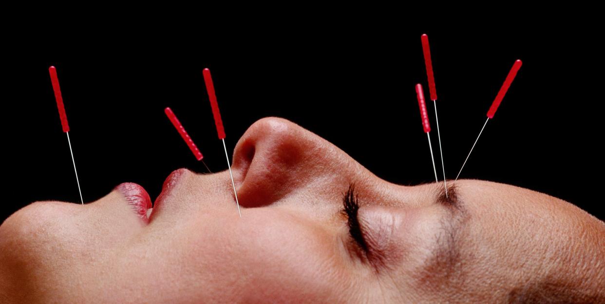 cosmetic acupuncture review