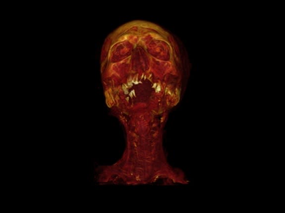 Across the globe and from several different time periods, mummies exhibited signs of narrowed arteries in CT scans. Here, a mummy shows signs of carotid artery narrowing.