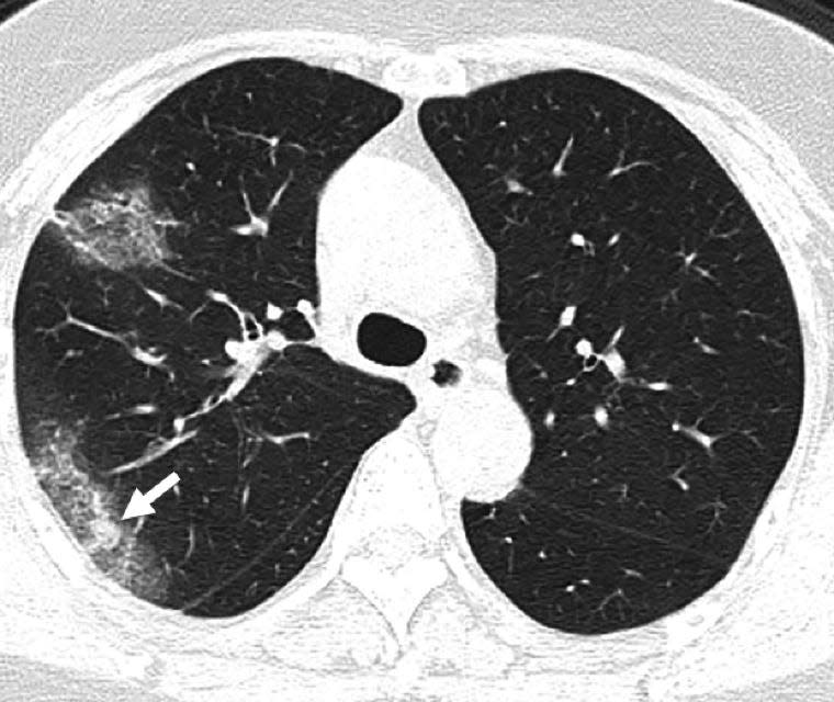 ground glass coronavirus lung