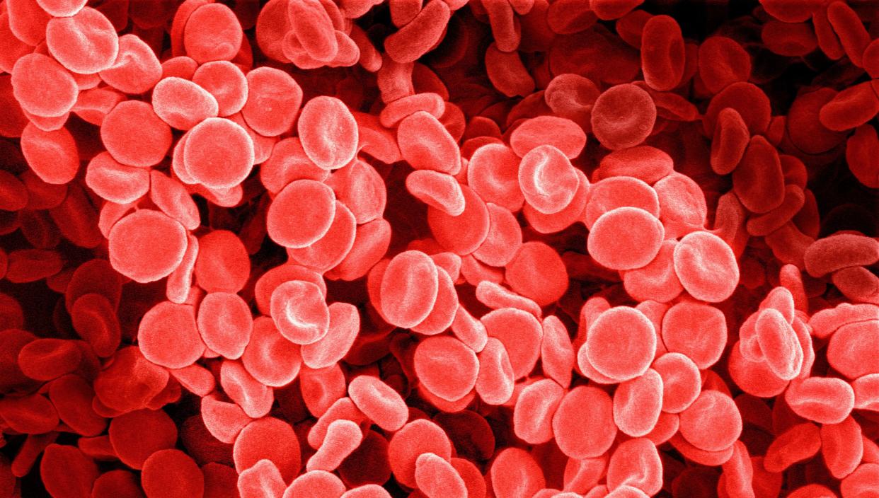 Being iron deficient means lacking enough healthy red blood cells.