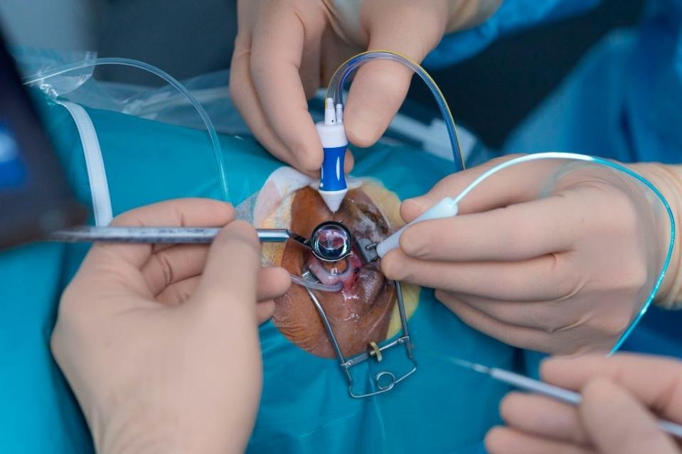 Close-up of a surgical procedure on a human eye, with multiple gloved hands using medical instruments for precision work