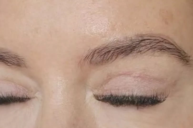 A beautician spent £1.2k on surgery to have her upper eyelids partially removed