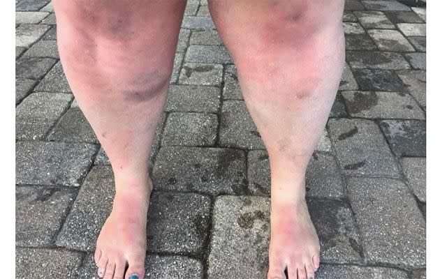 These are her bruised and battered legs after she passed the test. Photo: Instagram