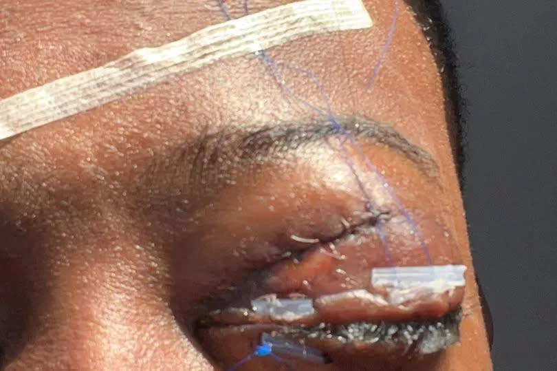 Farid's eye post-surgery -Credit:Collect/PA Real Life