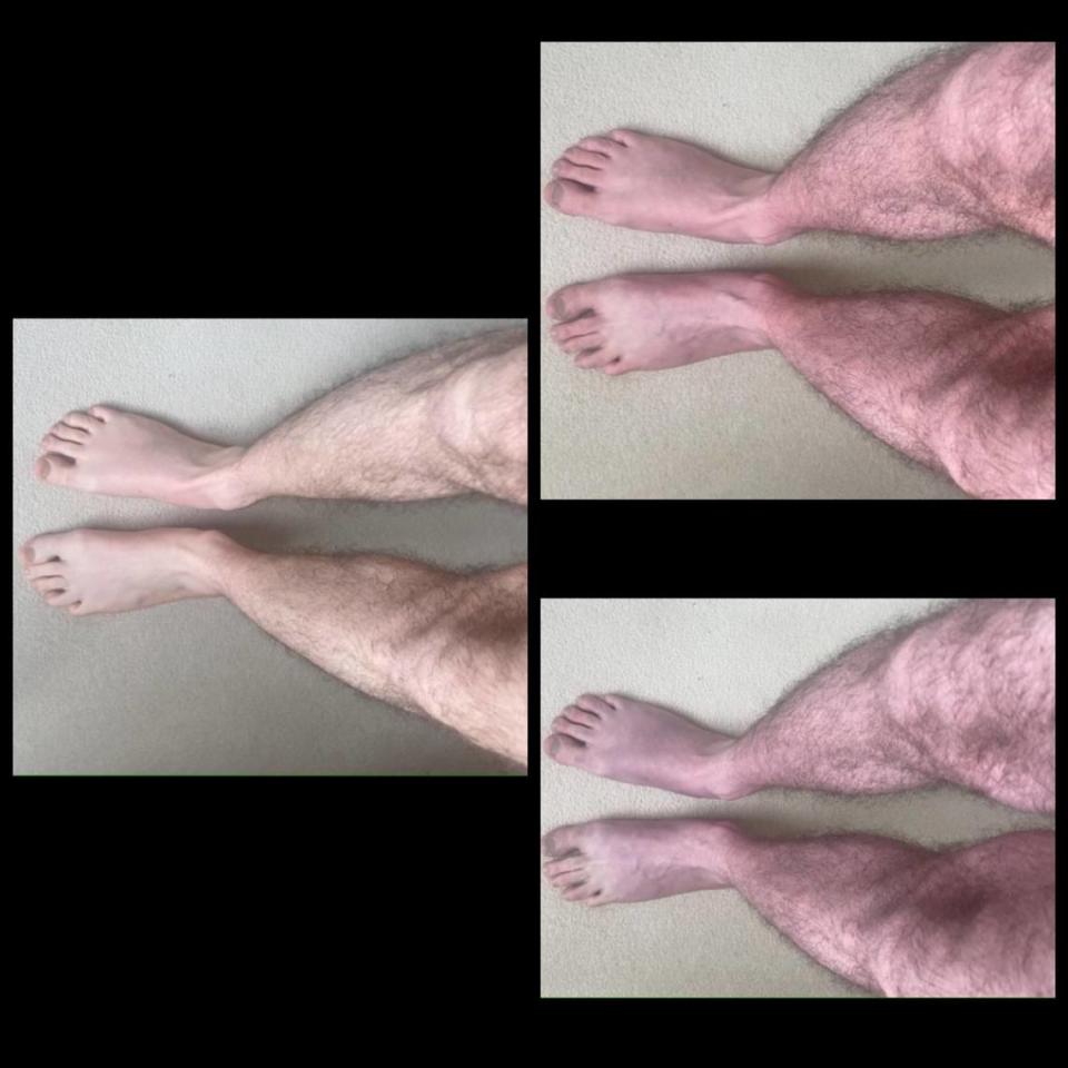 When the man stood for 0 minutes, left, his legs were normal. But when he stood for 2 minutes, top right, or 10 minutes, bottom right, his legs became discolored and uncomfortable.