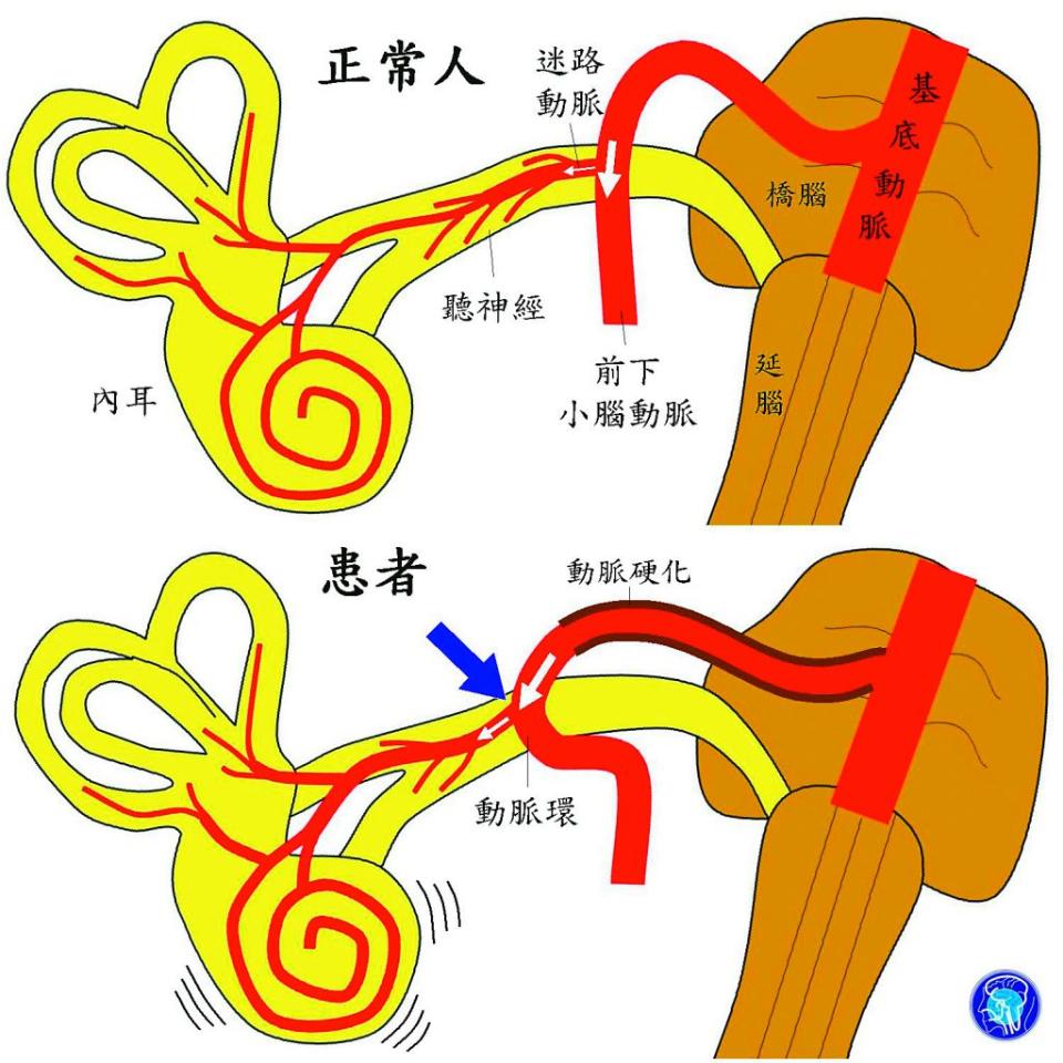 前下小腦動脈因動脈硬化，向內聽道延伸，未硬化處發生扭曲，血流方向改變，直接灌入迷路動脈，震動耳蝸管，產生搏動性耳鳴。（醫師陳建志提供）